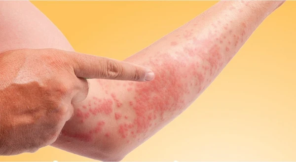 Mẩn ngứa ngoài da biểu hiện chức năng gan của chúng ta đang bị suy yếu